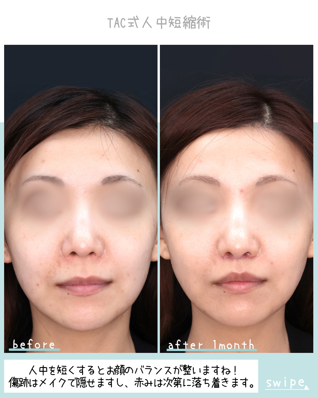 人中短縮術(リップリフト)・外側人中短縮術の症例写真 施術前後 