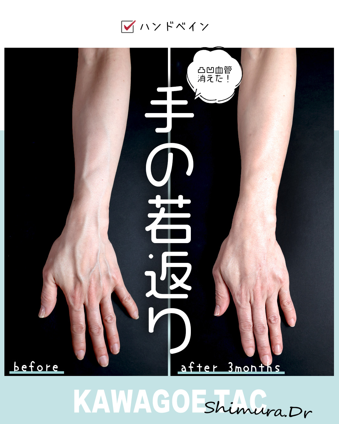 ハンドベイン（手のアンチエイジング・血管治療）の症例写真 施術前後 