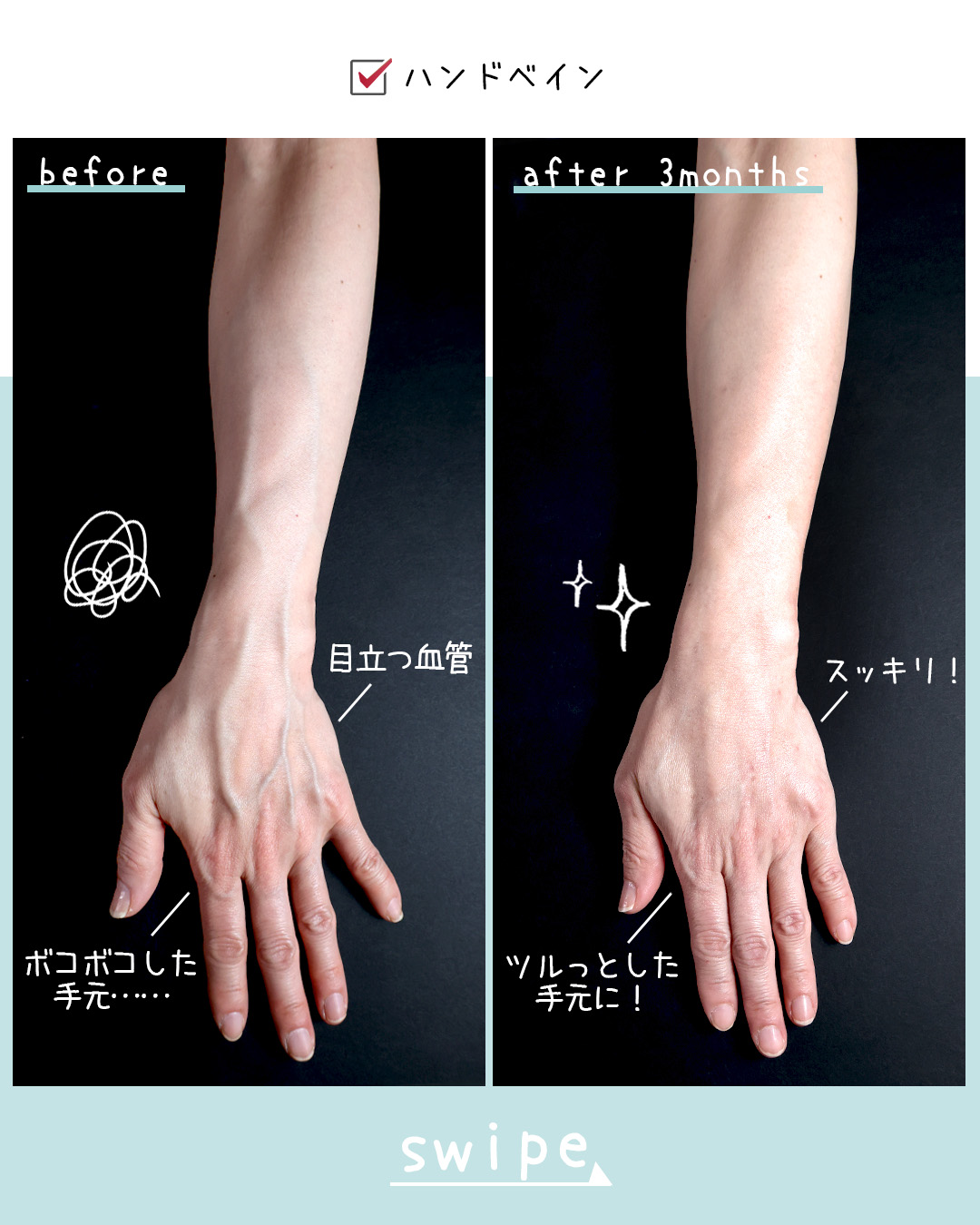 ハンドベイン（手のアンチエイジング・血管治療）の症例写真 施術前後 