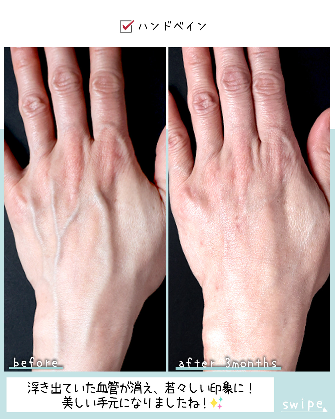 ハンドベイン（手のアンチエイジング・血管治療）の症例写真 施術前後 