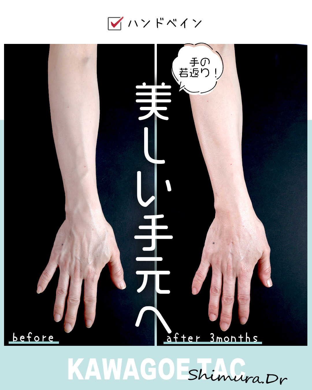 ハンドベイン（手のアンチエイジング・血管治療）の症例写真 施術前後 