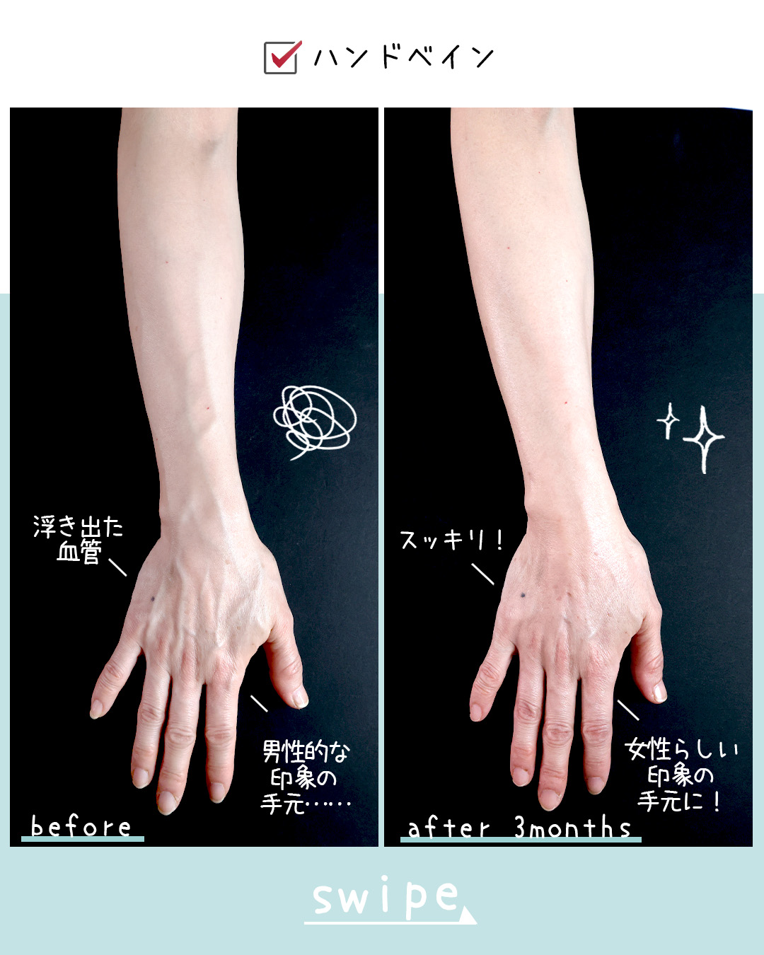 ハンドベイン（手のアンチエイジング・血管治療）の症例写真 施術前後 