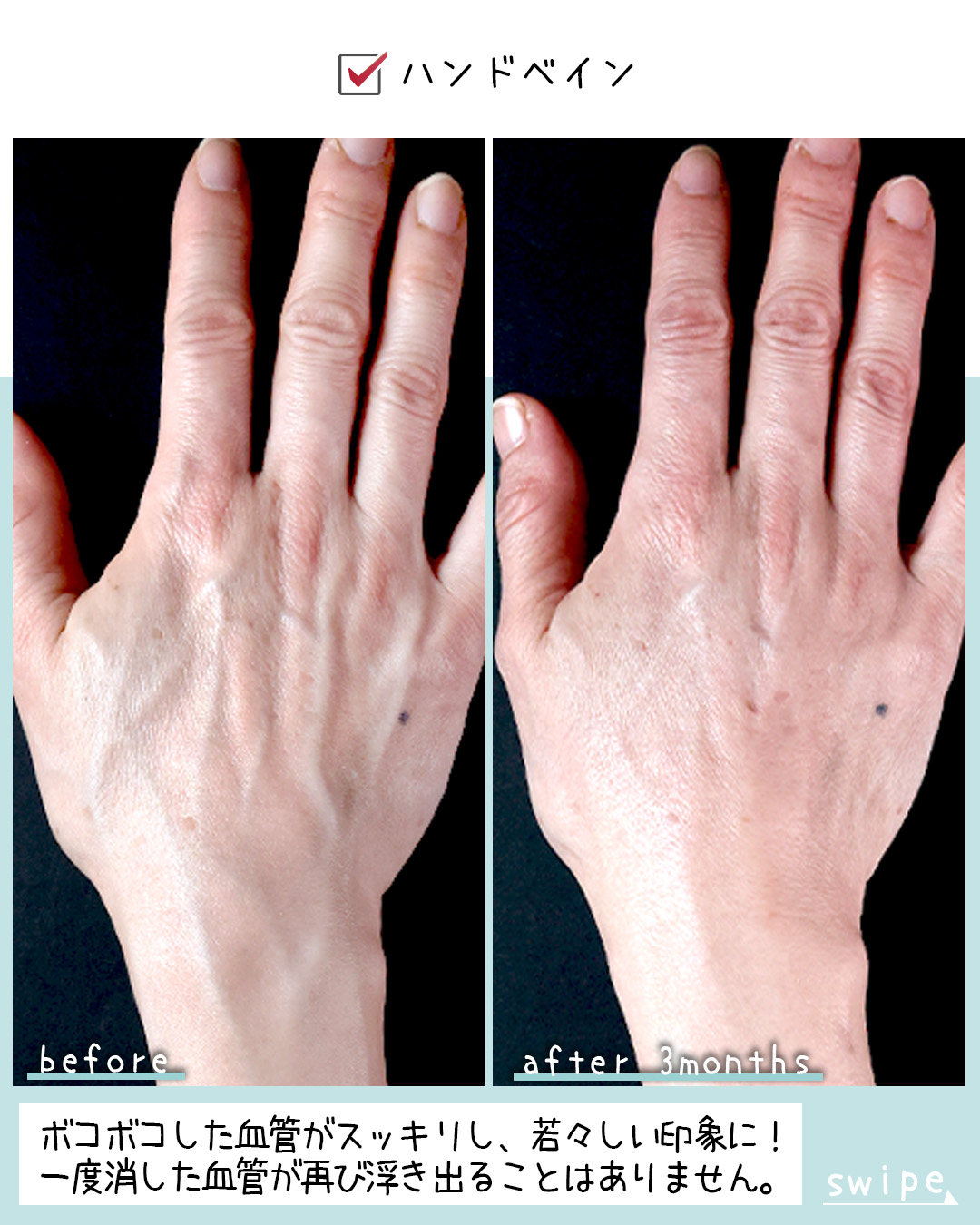 ハンドベイン（手のアンチエイジング・血管治療）の症例写真 施術前後 