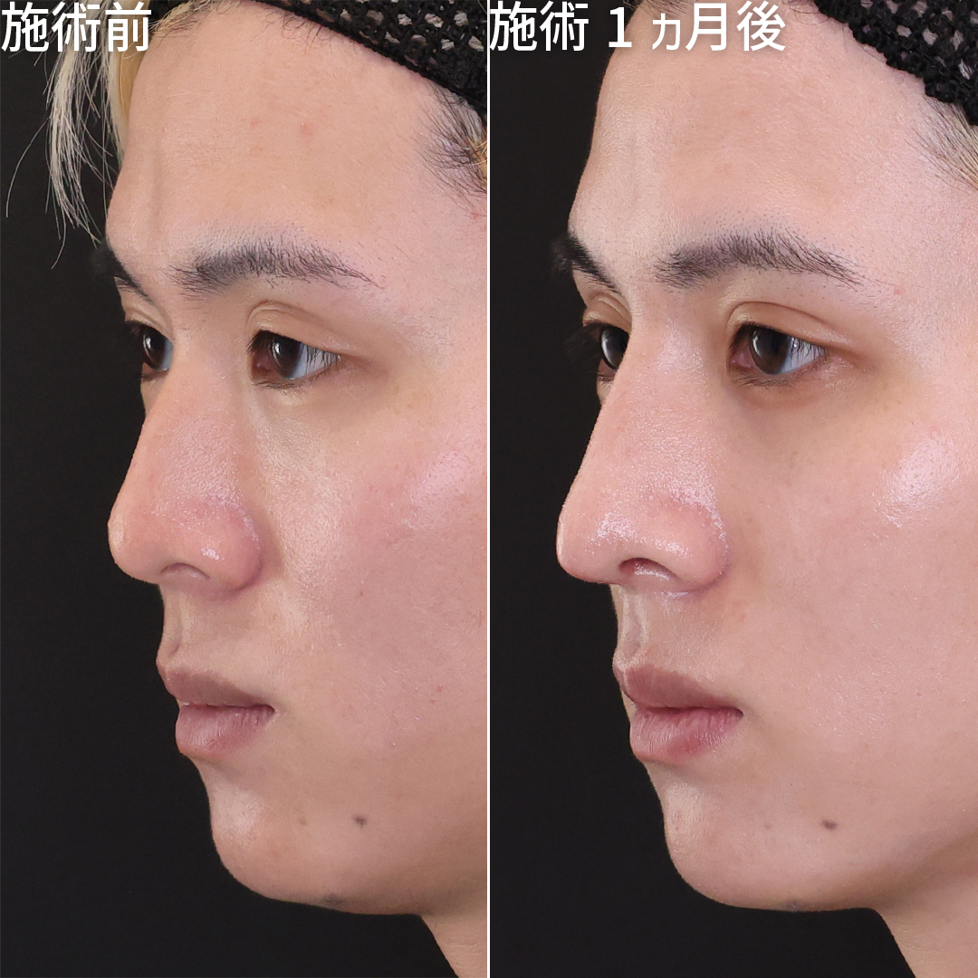 隆鼻術（プロテーゼ・自家組織）/鼻中隔延長術/鼻尖形成・鼻尖縮小の症例写真 施術前後 