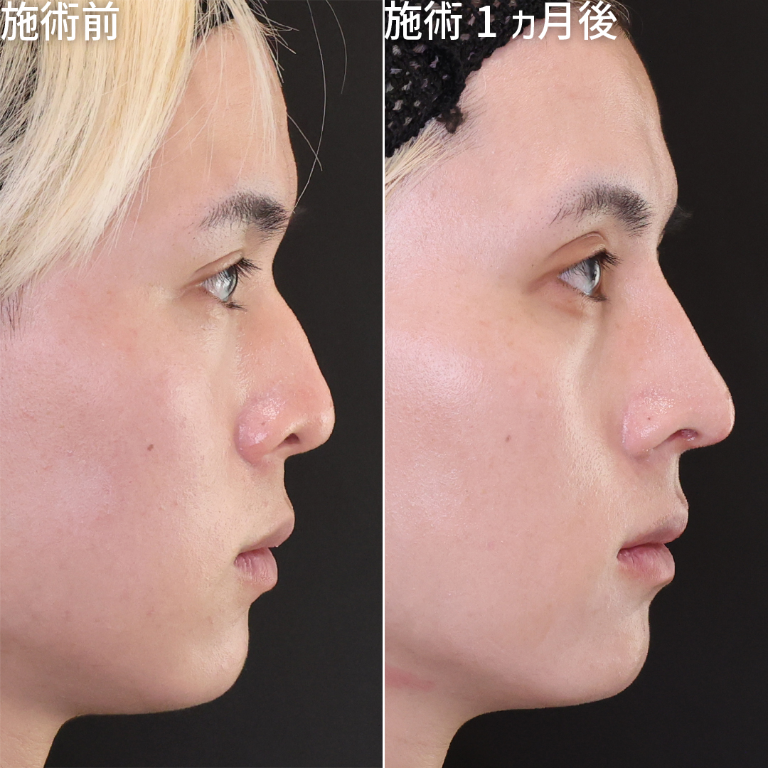 隆鼻術（プロテーゼ・自家組織）/鼻中隔延長術/鼻尖形成・鼻尖縮小の症例写真 施術前後 