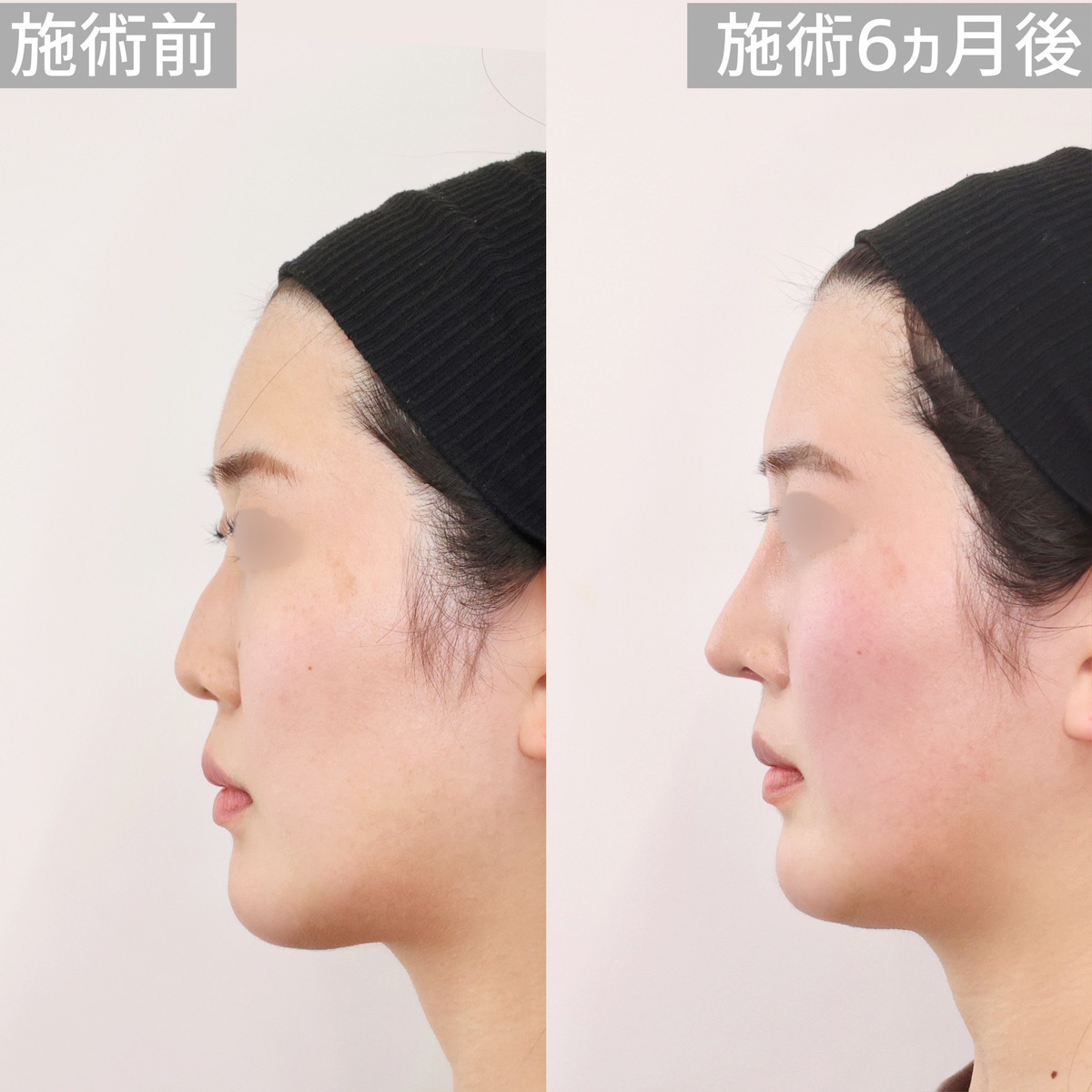 【ハンプ切除】わし鼻改善で女性らしい鼻に