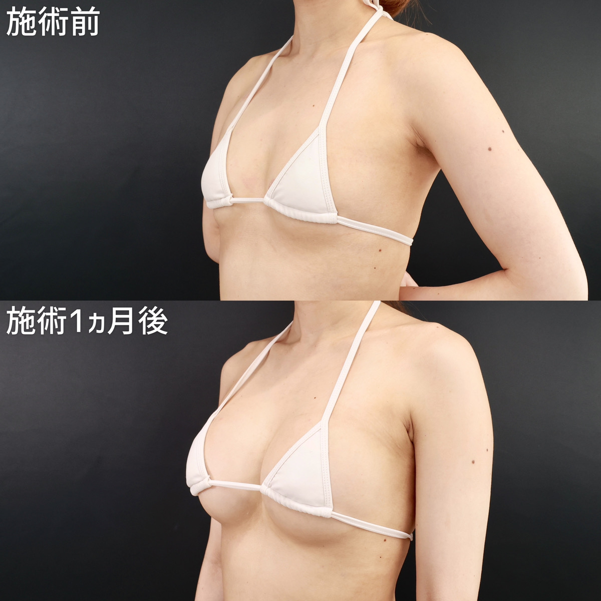 シリコンバッグ豊胸（人工乳腺バッグ）の症例写真 施術前後 