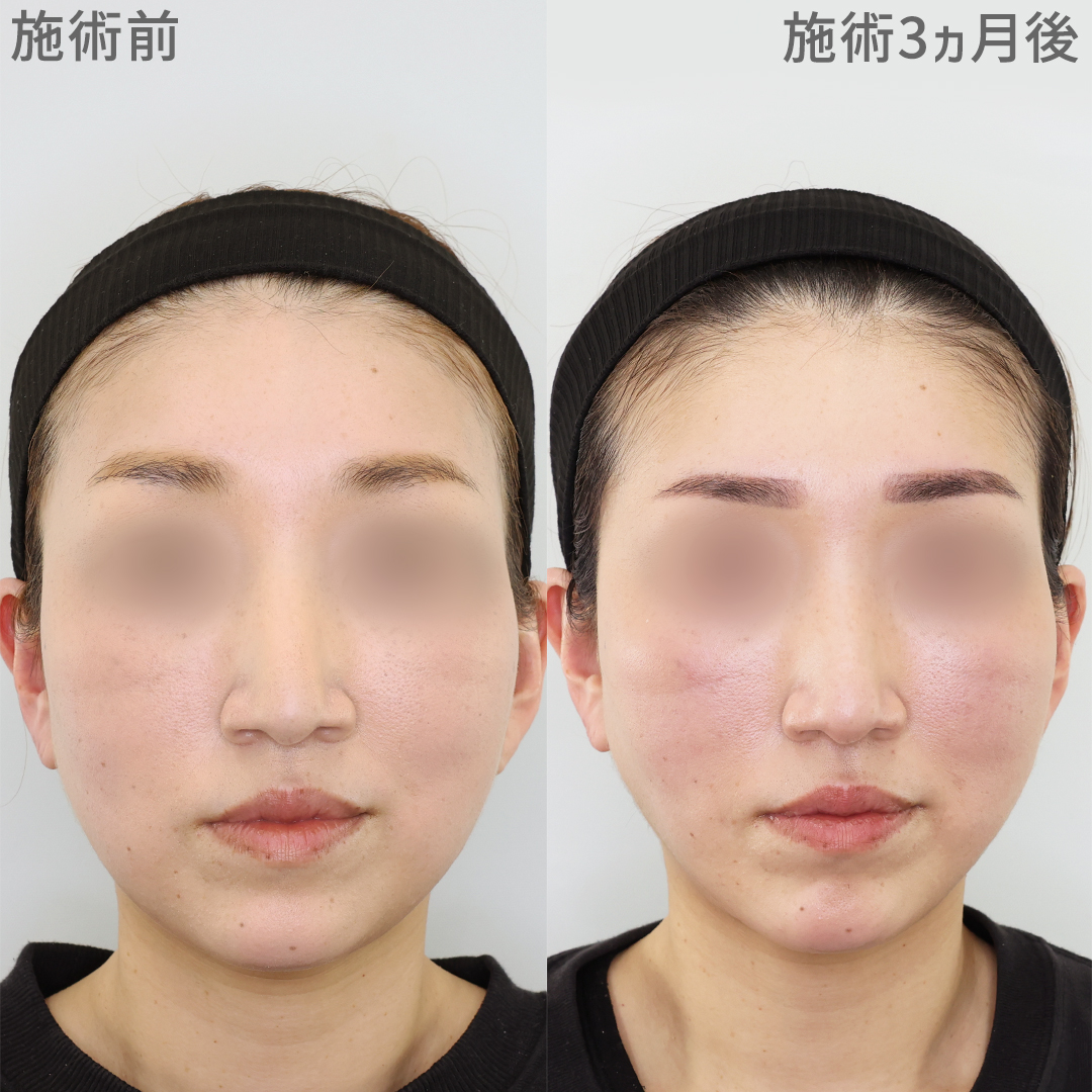 顎下と頬のボリュームを無くすTAC式《小顔術》