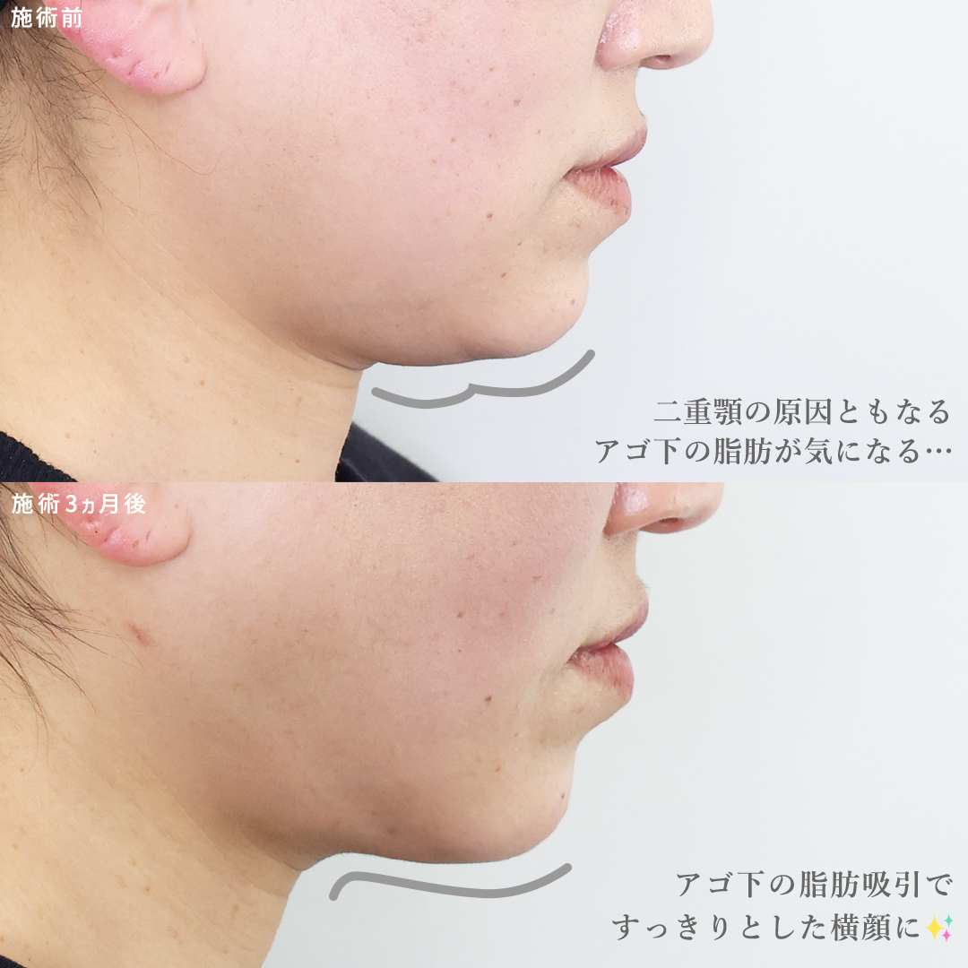 TAC式 ツヤ肌コラーゲンリフト®/ジョールファット除去/顔の脂肪吸引の症例写真 施術前後 