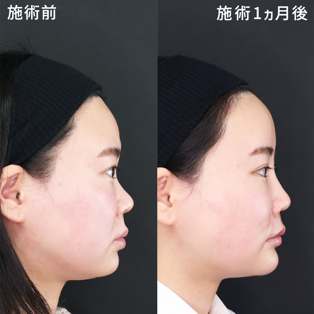 脂肪注入で丸みのあるおでこに【オルチャンデコ】