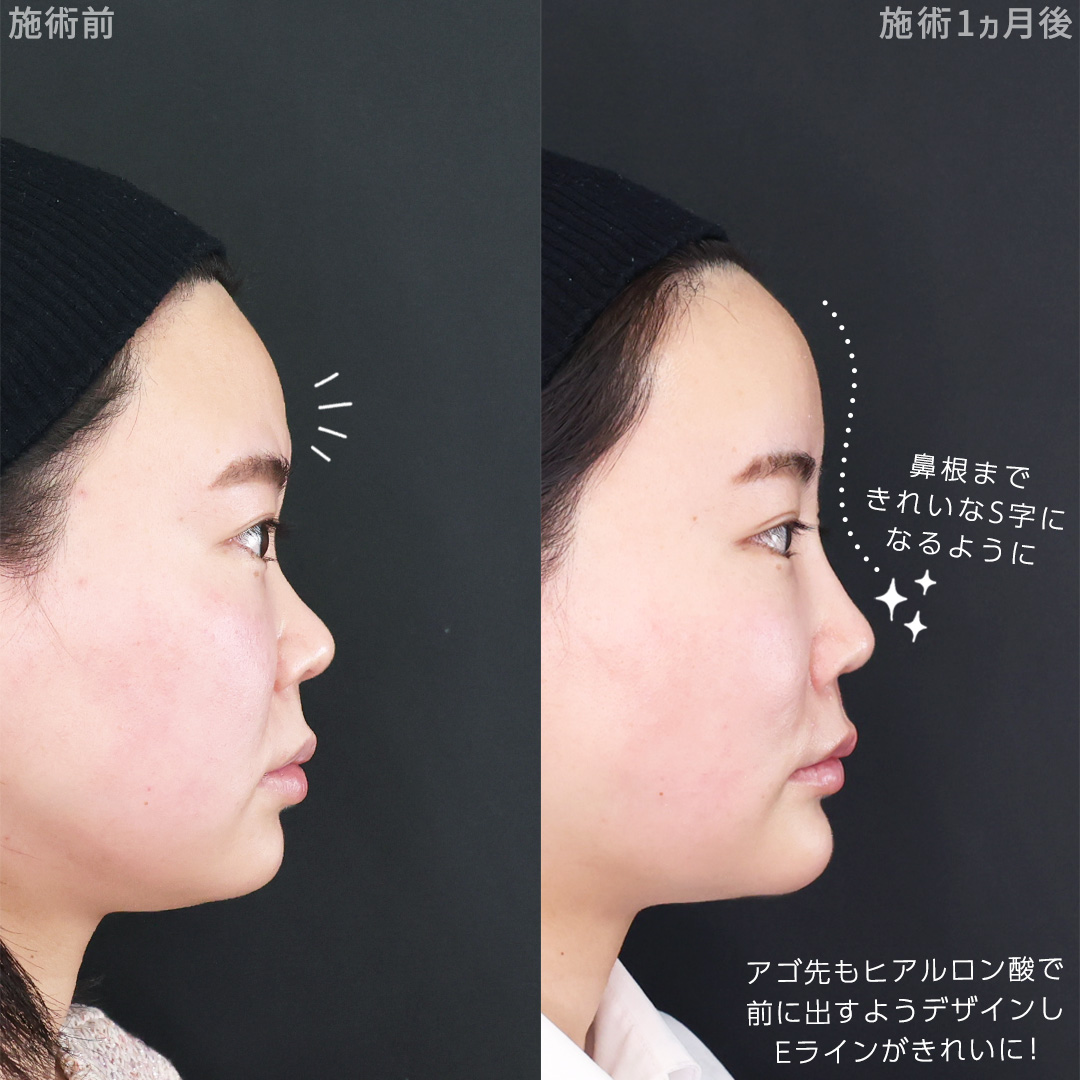 顔の脂肪注入(コンデンスリッチフェイス)/TAC式 ツヤ肌コラーゲンリフト®/バッカルファット除去の症例写真 施術前後 