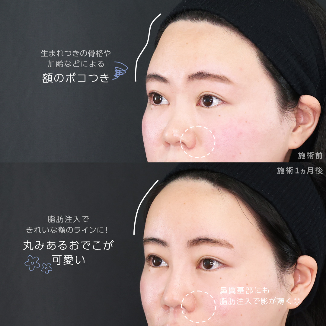 顔の脂肪注入(コンデンスリッチフェイス)/TAC式 ツヤ肌コラーゲンリフト®/バッカルファット除去の症例写真 施術前後 