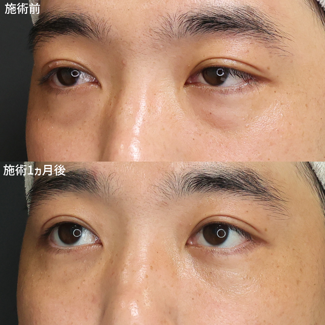 《クマ取り施術》目元のイメージ大きく変えませんか？