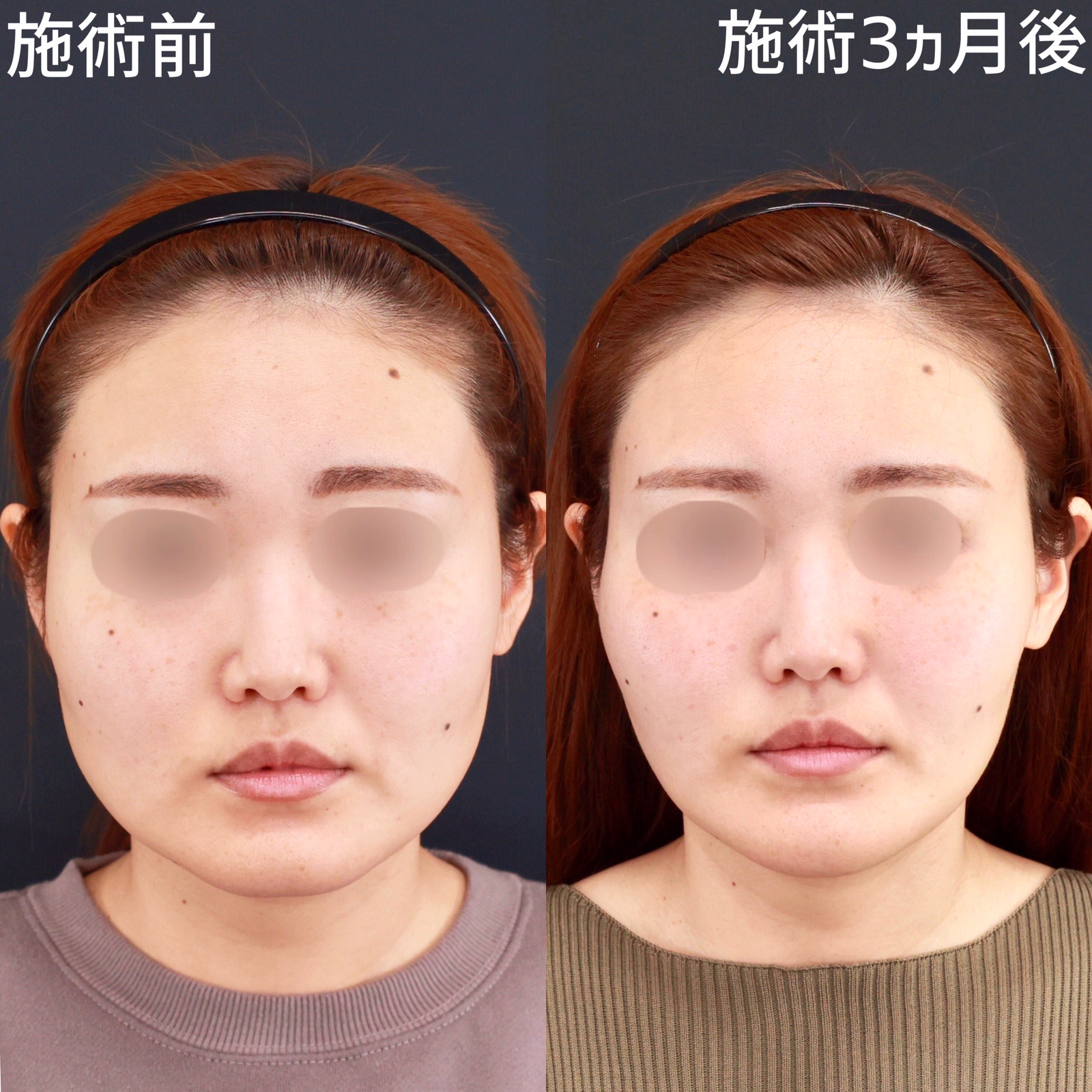 【糸リフト×ジョールファット除去】四角い輪郭から卵型に改善！