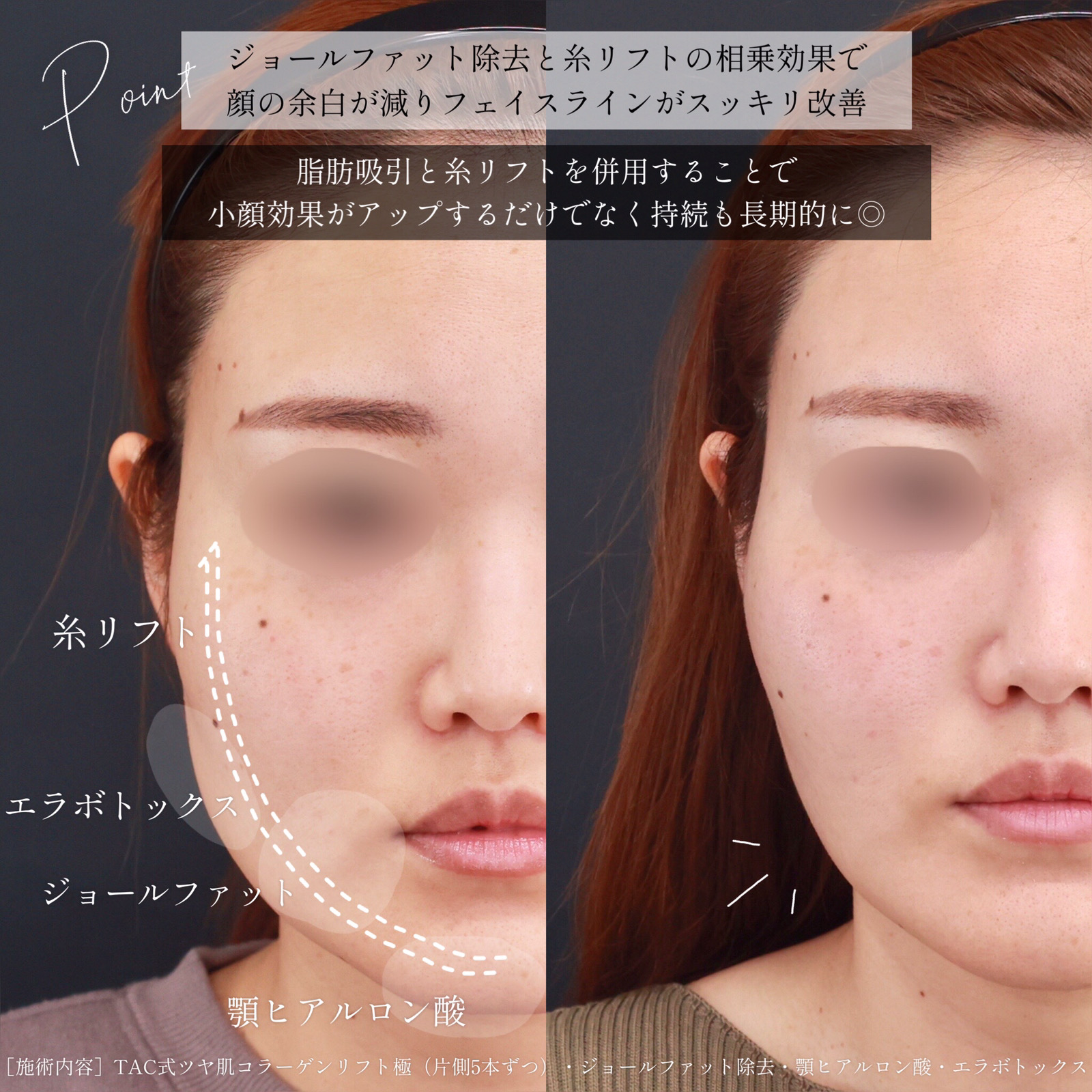 TAC式 ツヤ肌コラーゲンリフト®/ジョールファット除去/エラボトックス注射の症例写真 施術前後 