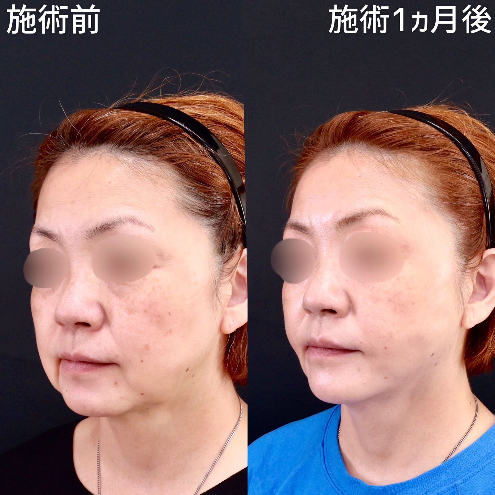 【糸リフト×ジョールファット除去】マリオネットラインをスッキリ改善！