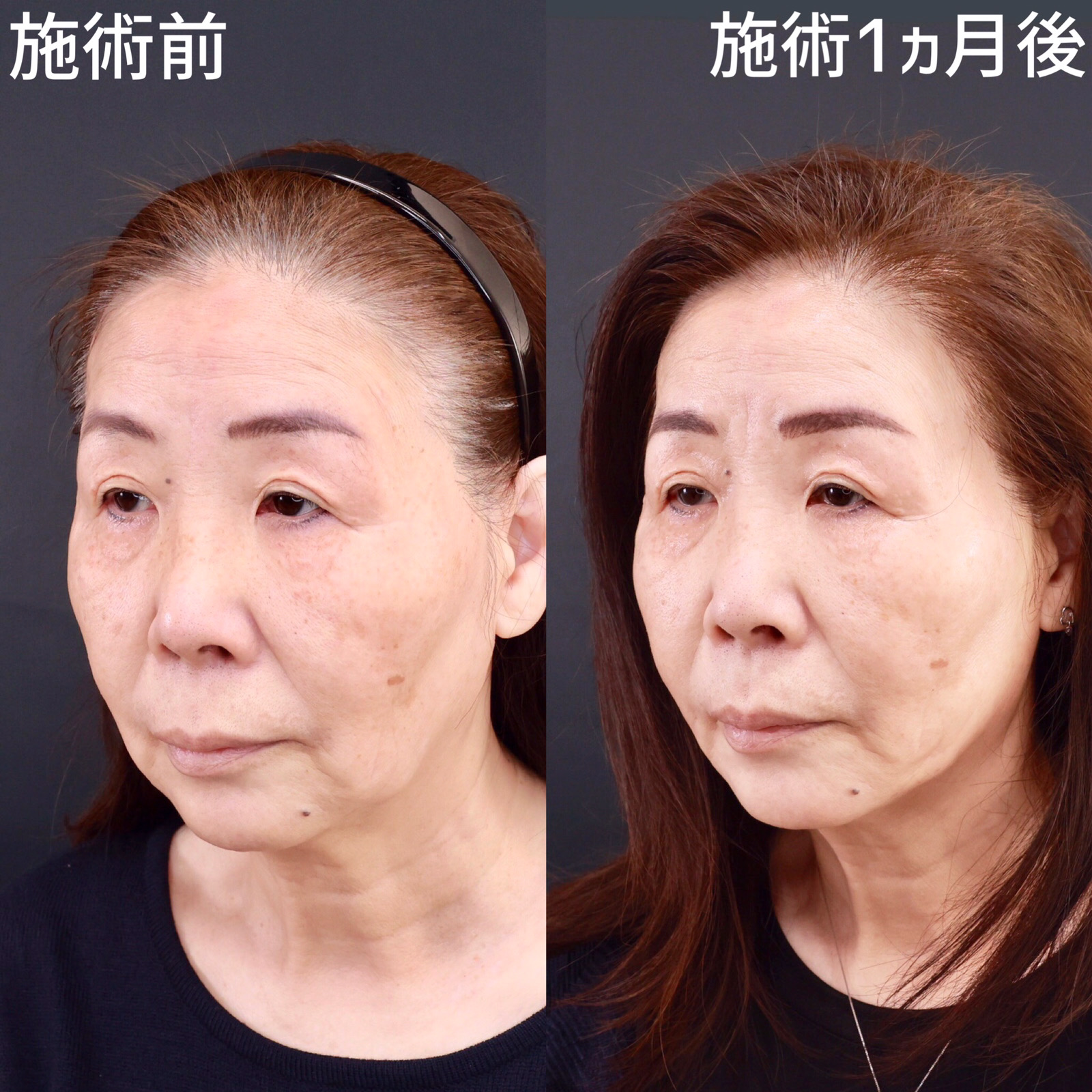 【糸リフト×ジョールファット除去】口横のたるみを改善！