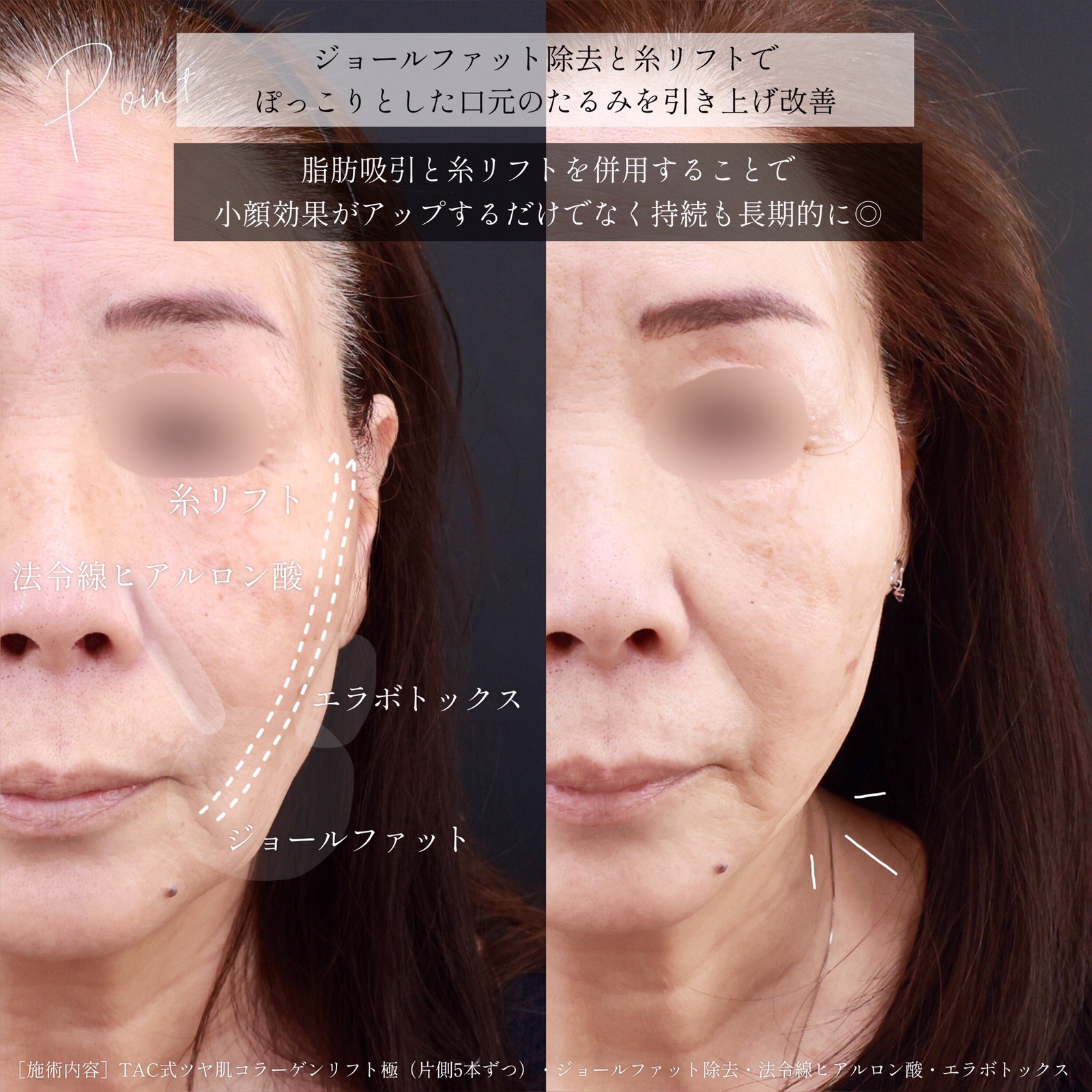 TAC式 ツヤ肌コラーゲンリフト®/ジョールファット除去/ほうれい線のヒアルロン酸注射の症例写真 施術前後 