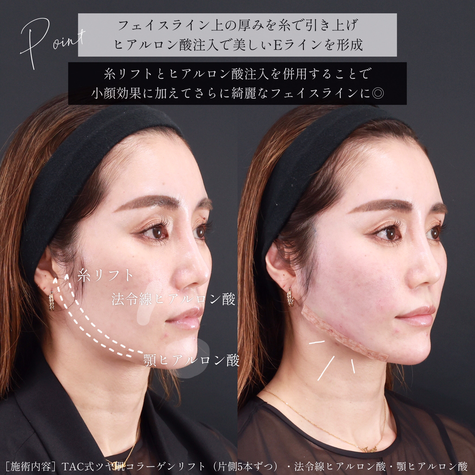 TAC式 ツヤ肌コラーゲンリフト®/顎のヒアルロン酸注射/ほうれい線のヒアルロン酸注射の症例写真 施術前後