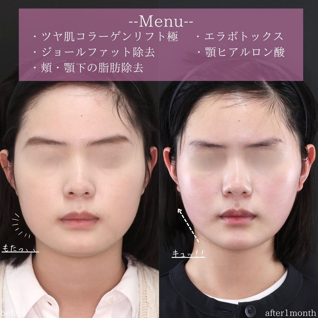 TAC式 ツヤ肌コラーゲンリフト®/ジョールファット除去/エラボトックス注射の症例写真 施術前後 