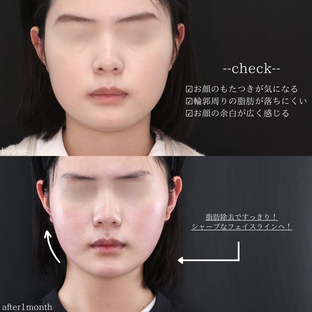TAC式 ツヤ肌コラーゲンリフト®/ジョールファット除去/エラボトックス注射の症例写真 施術前後 