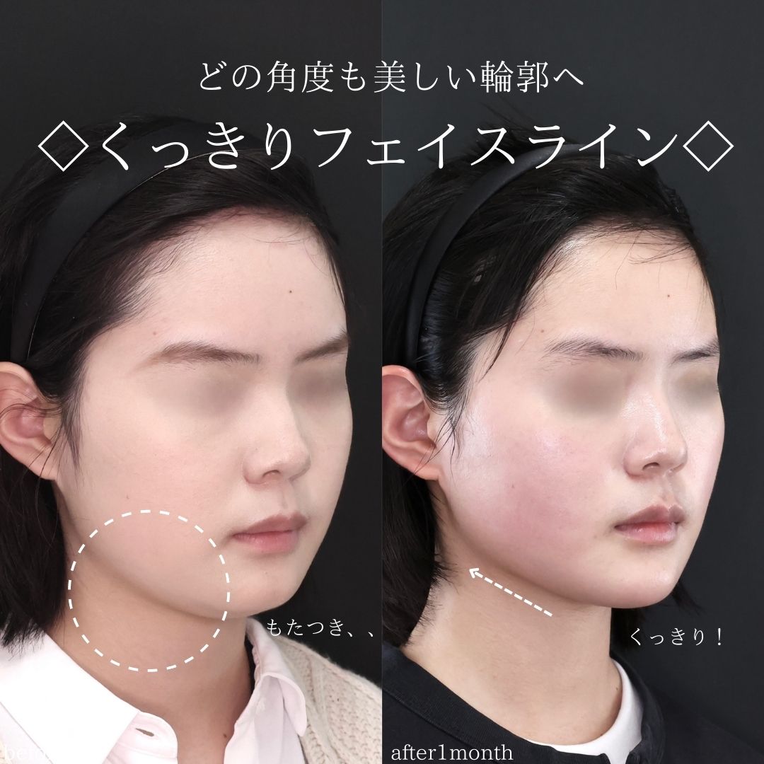 TAC式 ツヤ肌コラーゲンリフト®/ジョールファット除去/エラボトックス注射の症例写真 施術前後 