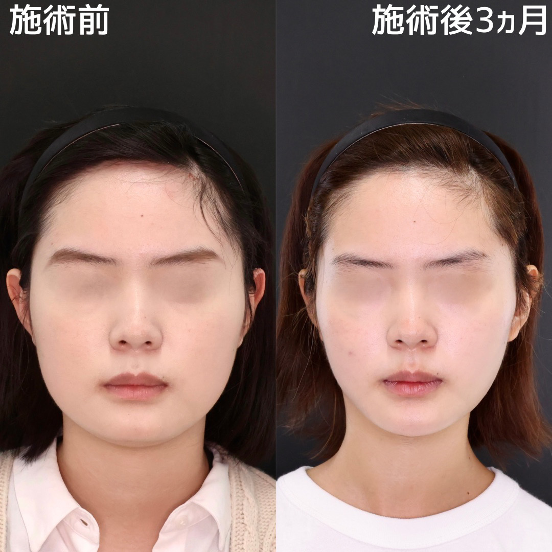 TAC式 ツヤ肌コラーゲンリフト®/ジョールファット除去/エラボトックス注射の症例写真 施術前後 