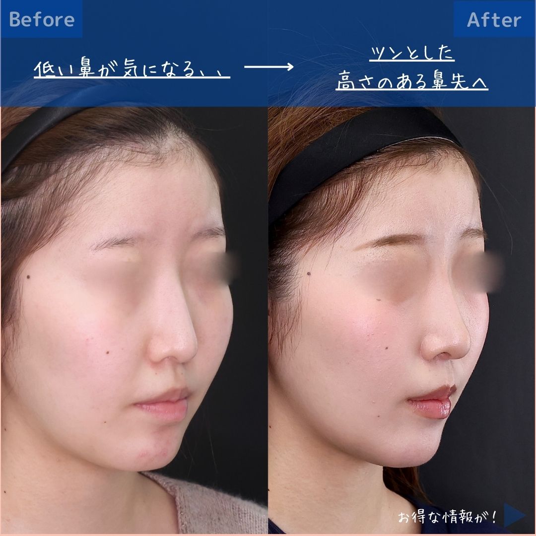 鼻先軟骨移植/鼻尖形成・鼻尖縮小の症例写真 施術前後 