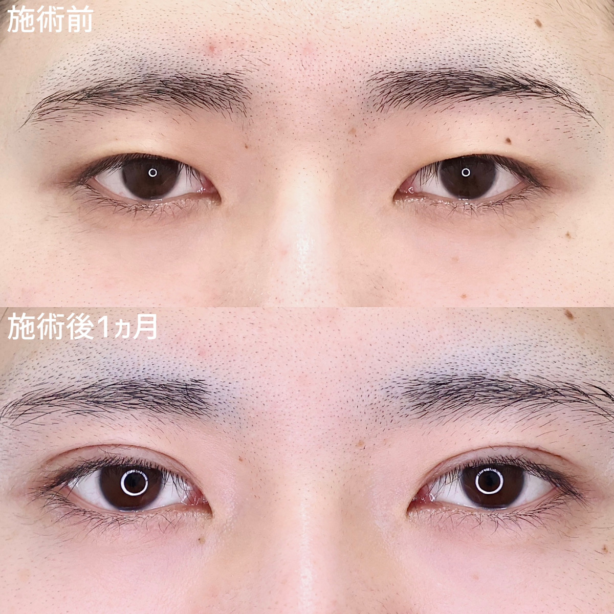 二重にしただけでイケメンに！【二重埋没法】