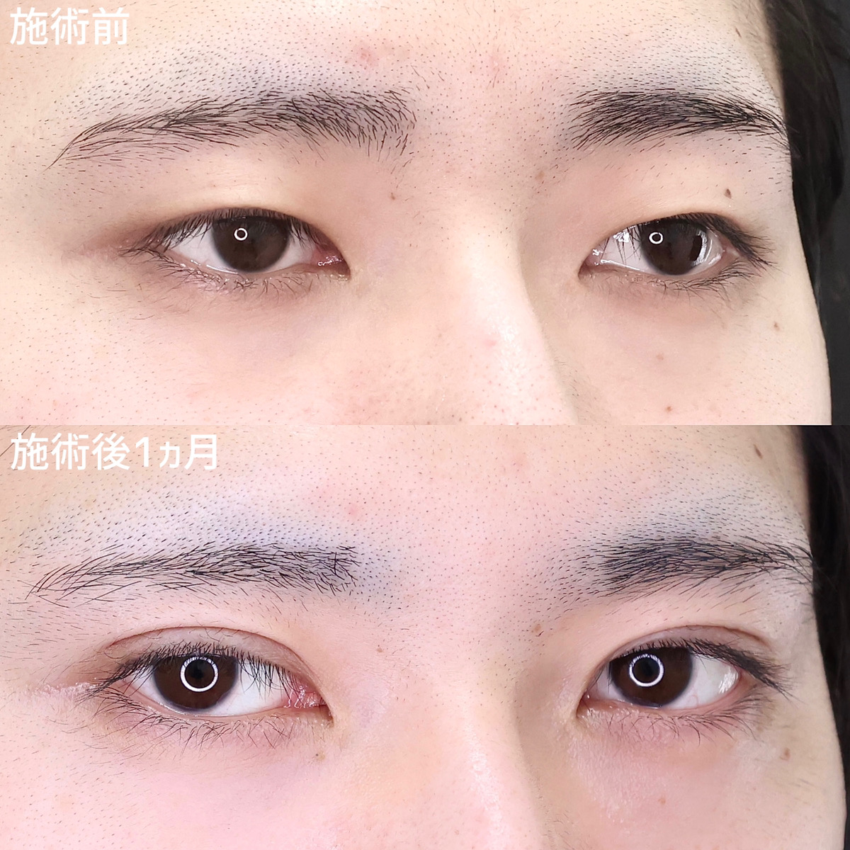 二重埋没法の症例写真 施術前後 