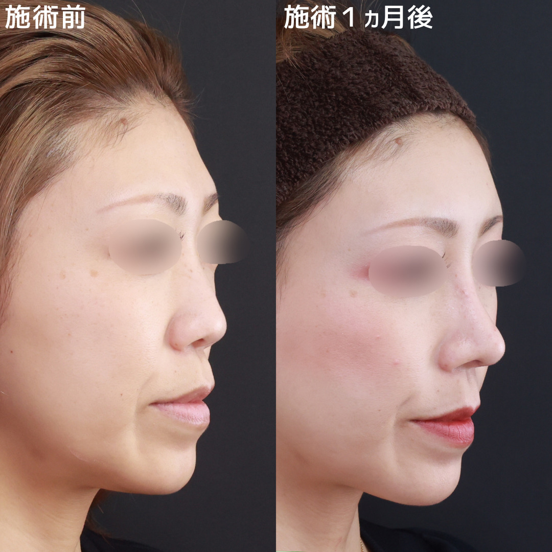 【鼻×額の複合施術】Ｓ字ラインが美しく整った横顔へ