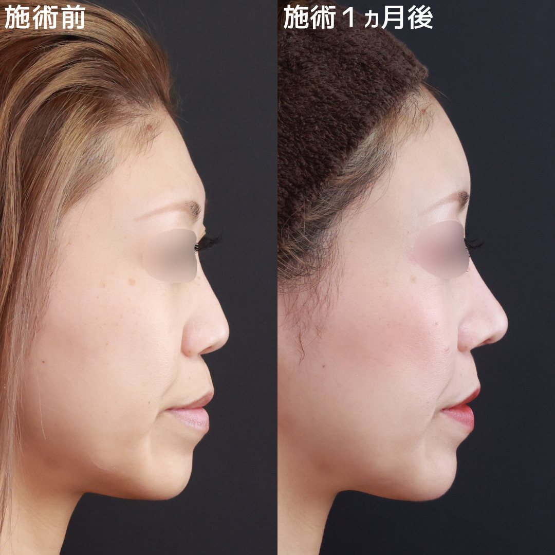 鼻尖形成・鼻尖縮小/鼻先軟骨移植/鼻中隔延長術の症例写真 施術前後 