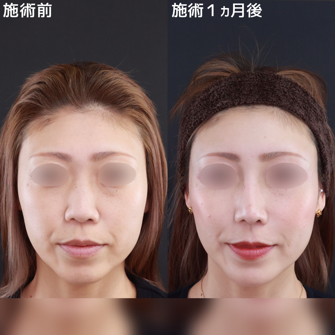 鼻尖形成・鼻尖縮小/鼻先軟骨移植/鼻中隔延長術の症例写真 施術前後 
