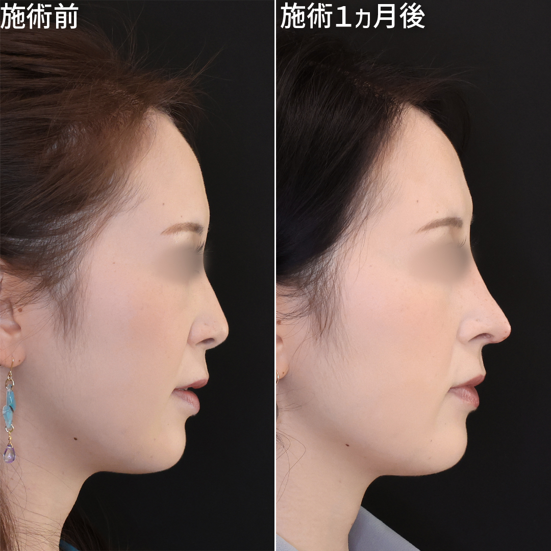 鼻中隔延長術/鼻尖形成・鼻尖縮小/鼻先軟骨移植の症例写真 施術前後 