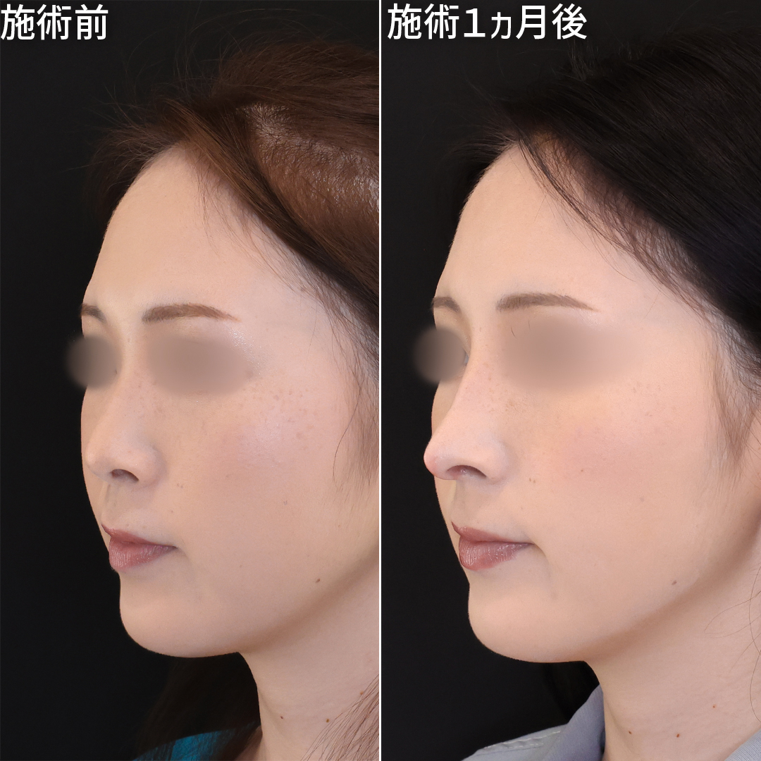 鼻中隔延長術/鼻尖形成・鼻尖縮小/鼻先軟骨移植の症例写真 施術前後 