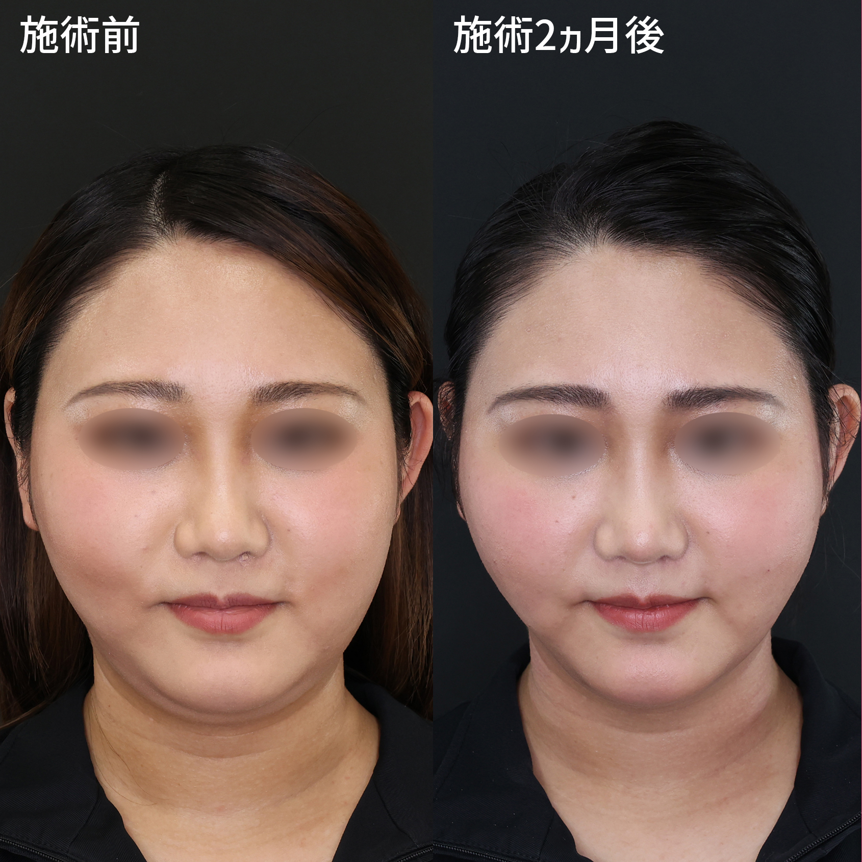 周りから憧れられるフェイスラインへ【Lラインファット除去×糸リフト】