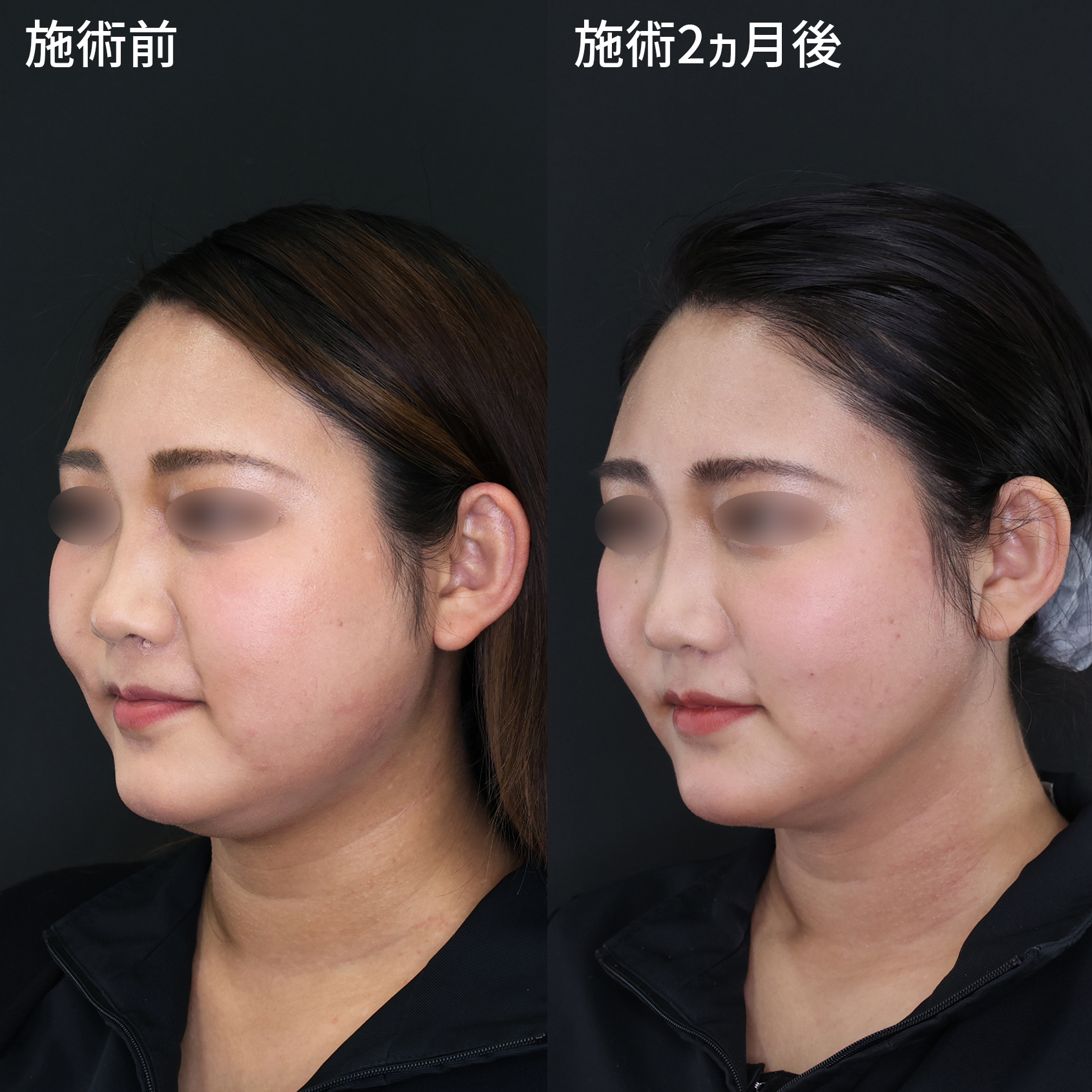 Lラインファット除去（エラ下脂肪除去）/TAC式 ツヤ肌コラーゲンリフト®の症例写真 施術前後 