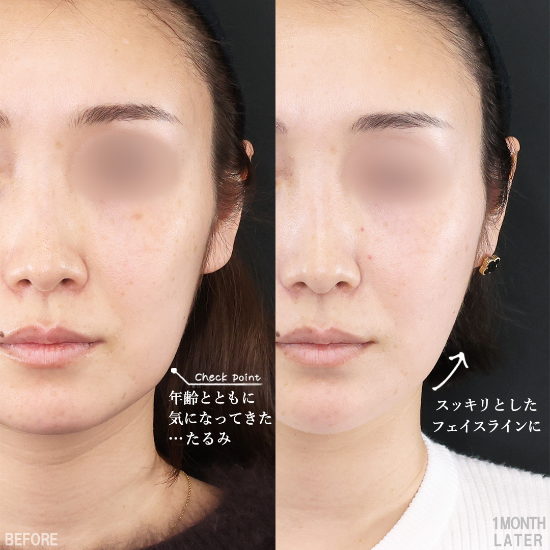 TAC式 ツヤ肌コラーゲンリフト®/TAC式 ショッピングリフト/顎のヒアルロン酸注射の症例写真 施術前後 