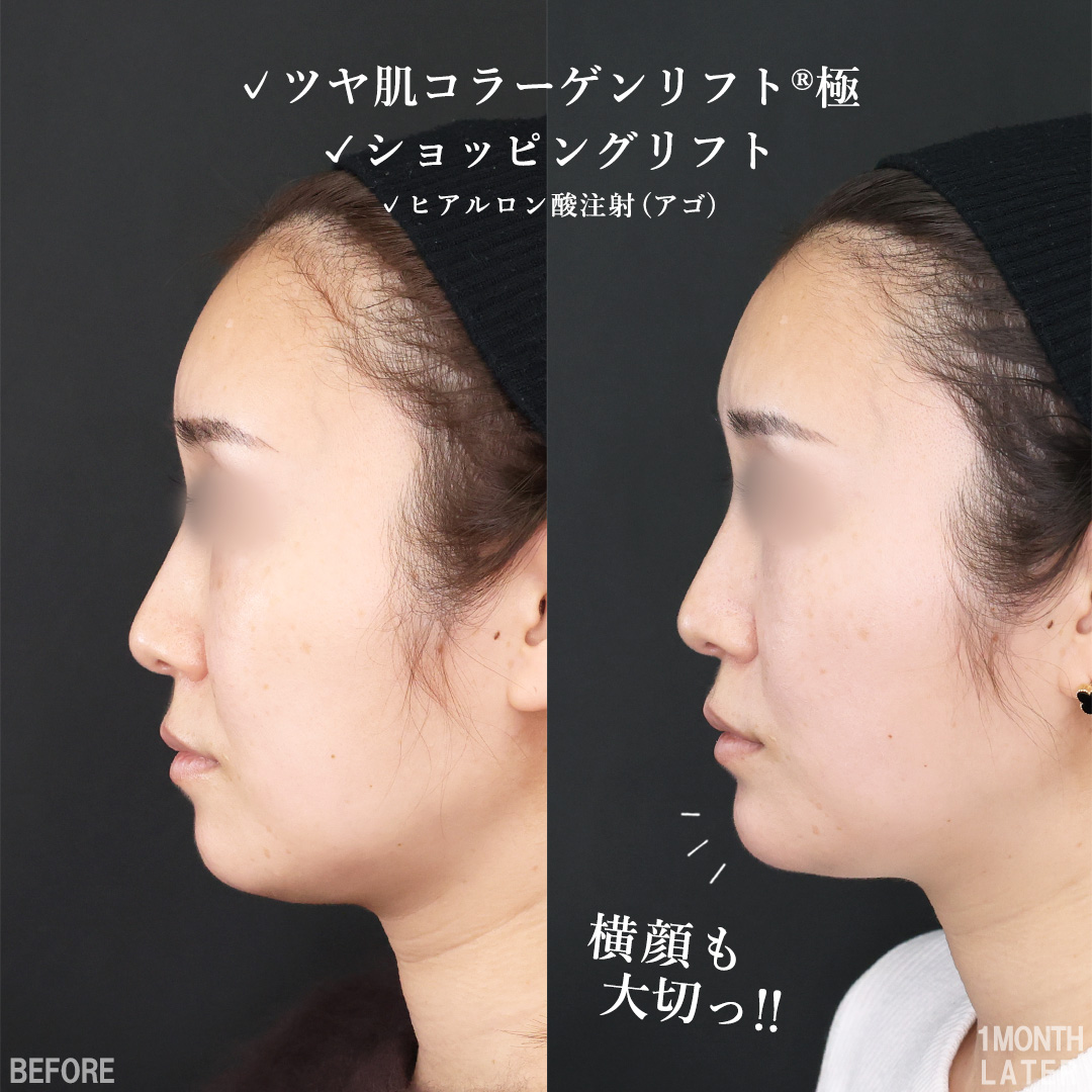 TAC式 ツヤ肌コラーゲンリフト®/TAC式 ショッピングリフト/顎のヒアルロン酸注射の症例写真 施術前後 