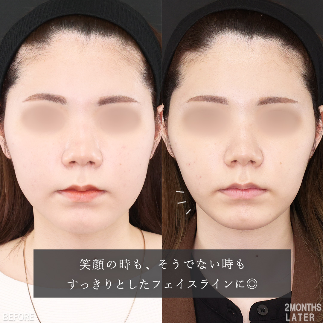 TAC式 ツヤ肌コラーゲンリフト®/顔の脂肪吸引/バッカルファット除去の症例写真 施術前後