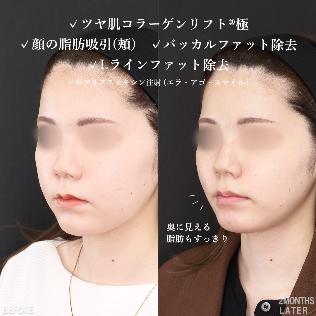 TAC式 ツヤ肌コラーゲンリフト®/顔の脂肪吸引/バッカルファット除去の症例写真 施術前後