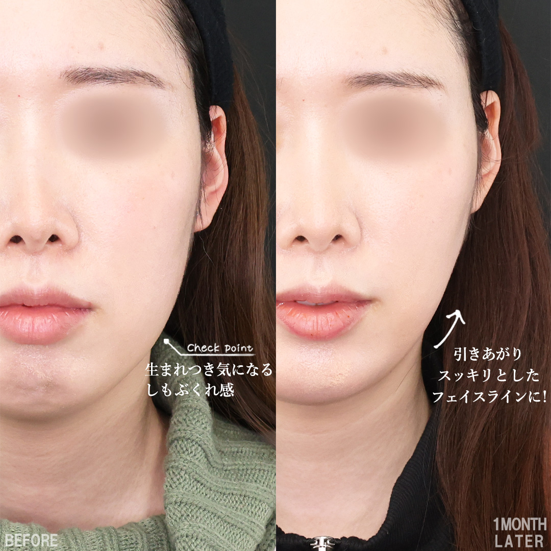 TAC式 ツヤ肌コラーゲンリフト®/顎下の脂肪吸引/Lラインファット除去（エラ下脂肪除去）の症例写真 施術前後 