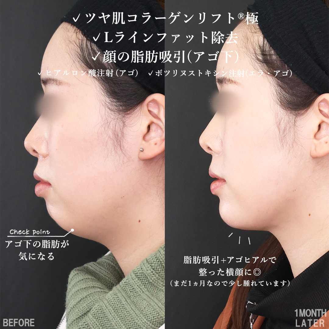 TAC式 ツヤ肌コラーゲンリフト®/顎下の脂肪吸引/Lラインファット除去（エラ下脂肪除去）の症例写真 施術前後 