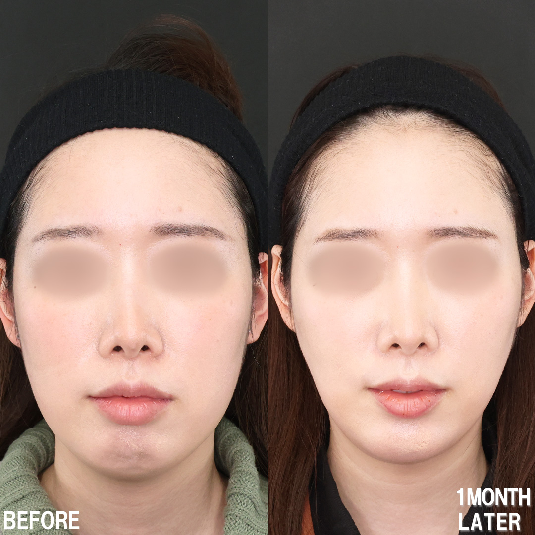 TAC式 ツヤ肌コラーゲンリフト®/顎下の脂肪吸引/Lラインファット除去（エラ下脂肪除去）の症例写真 施術前後 