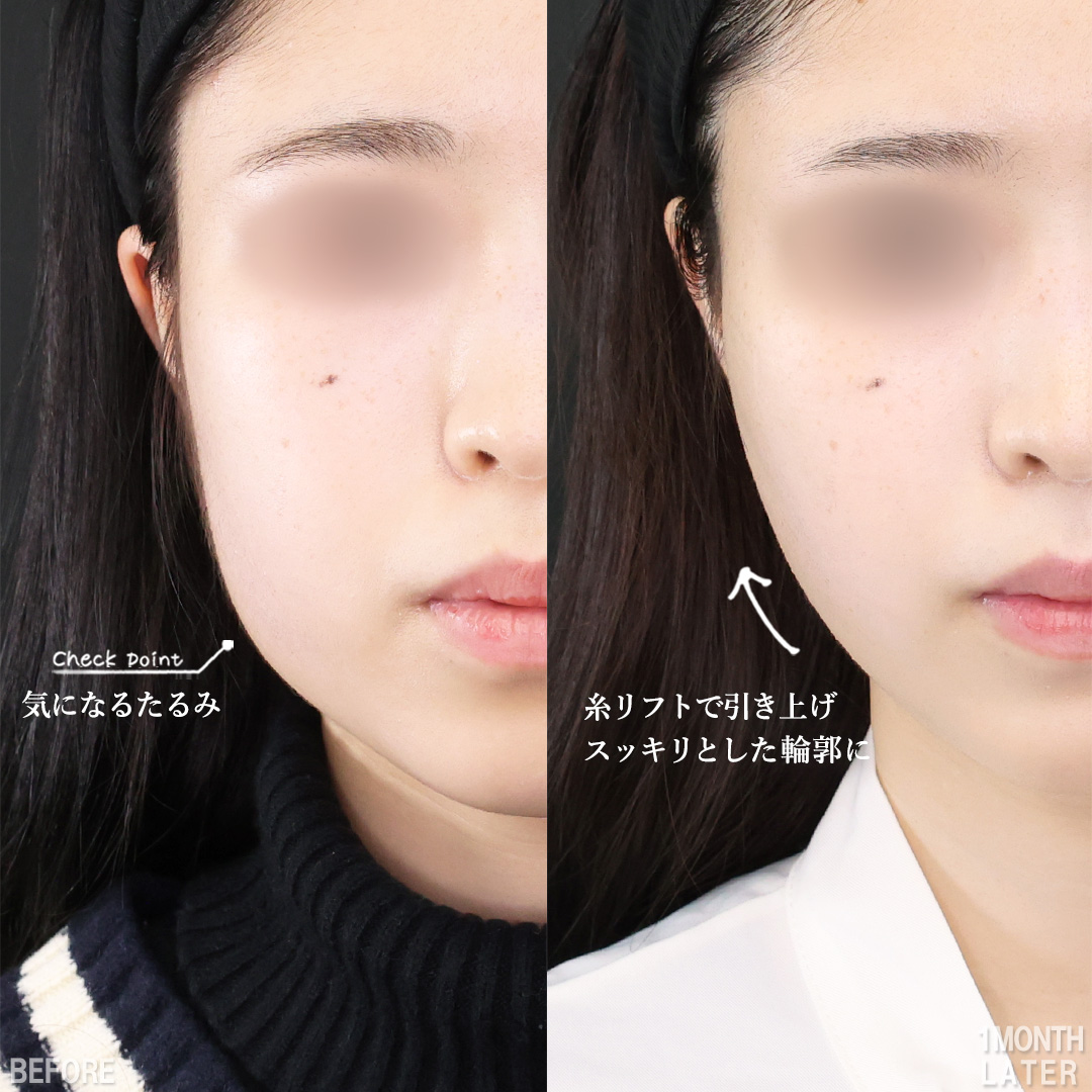 TAC式 ツヤ肌コラーゲンリフト®/顎のヒアルロン酸注射/ほうれい線のヒアルロン酸注射の症例写真 施術前後 