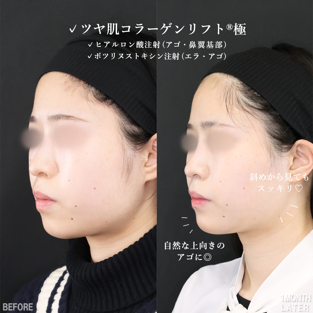 TAC式 ツヤ肌コラーゲンリフト®/顎のヒアルロン酸注射/ほうれい線のヒアルロン酸注射の症例写真 施術前後 