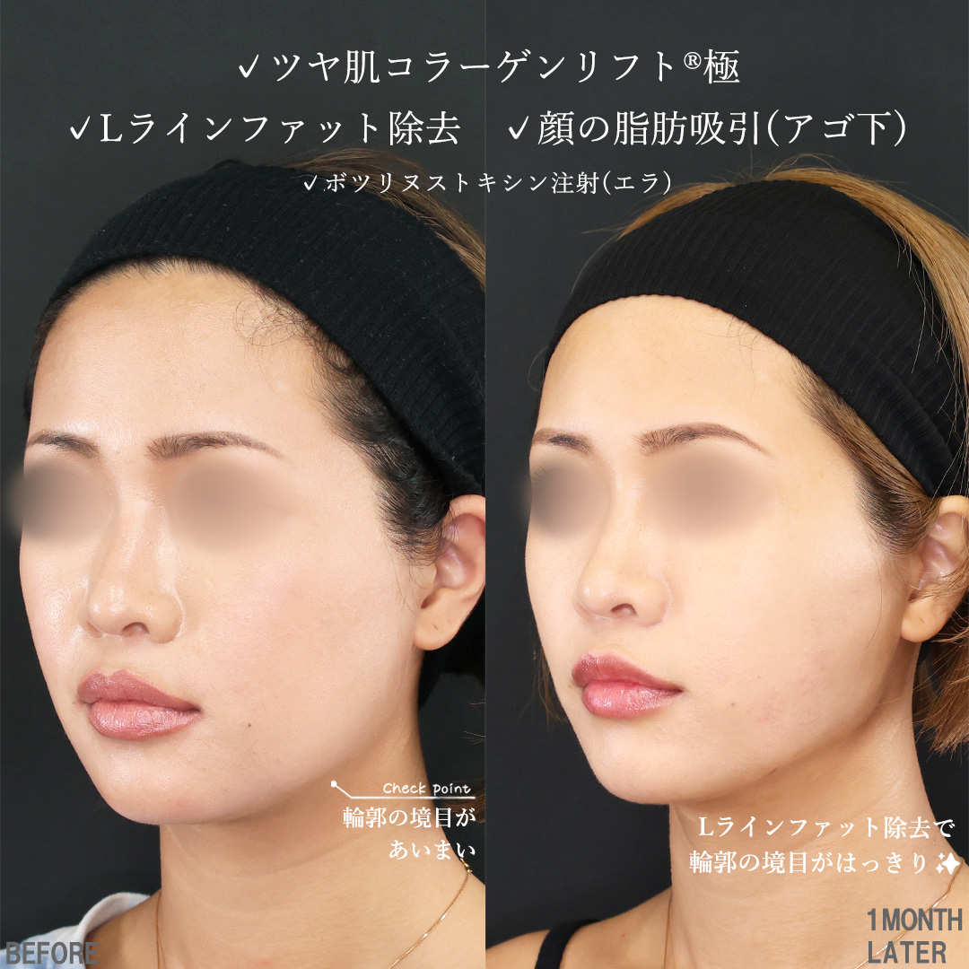 TAC式 ツヤ肌コラーゲンリフト®/Lラインファット除去（エラ下脂肪除去）/顎下の脂肪吸引の症例写真 施術前後 