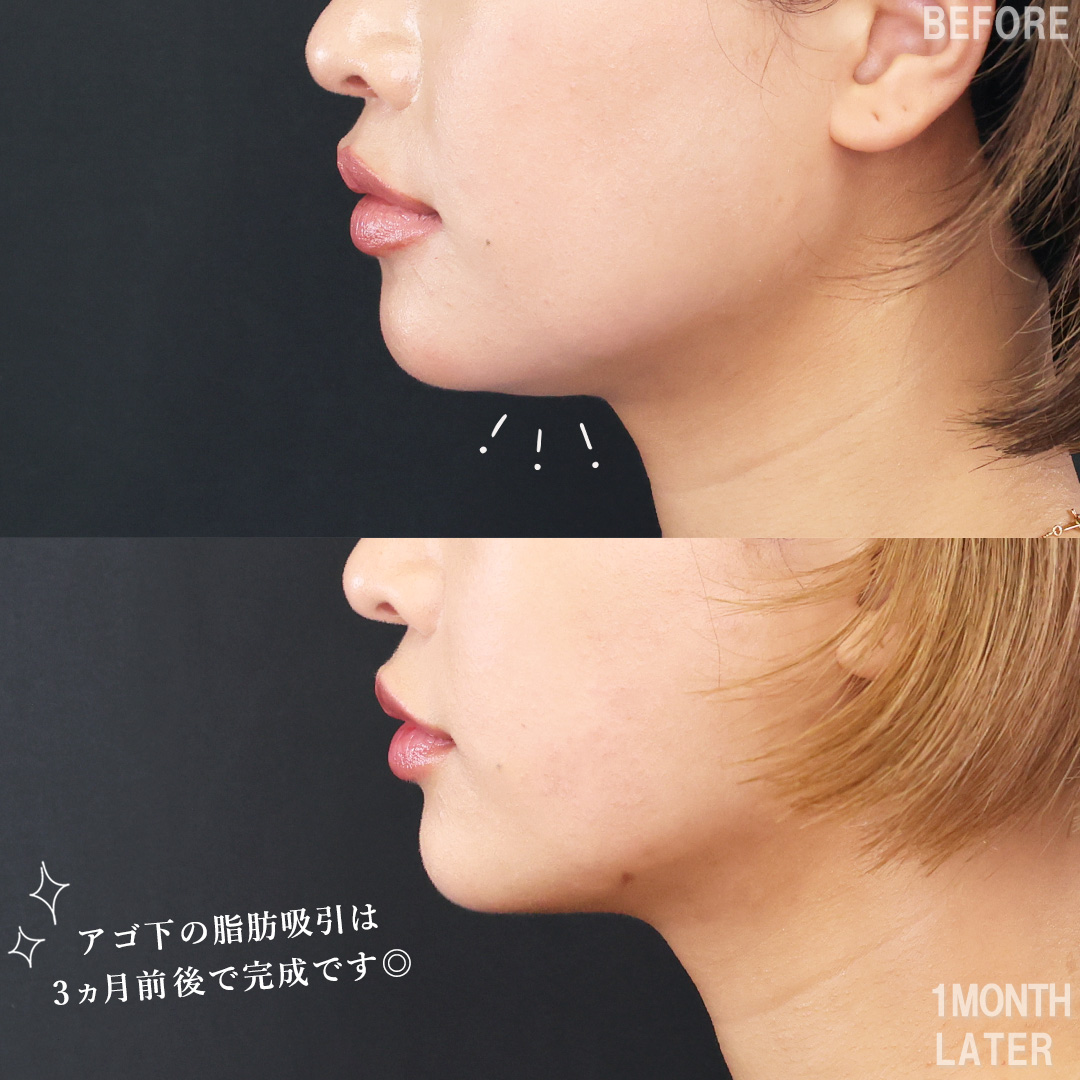 TAC式 ツヤ肌コラーゲンリフト®/Lラインファット除去（エラ下脂肪除去）/顎下の脂肪吸引の症例写真 施術前後 