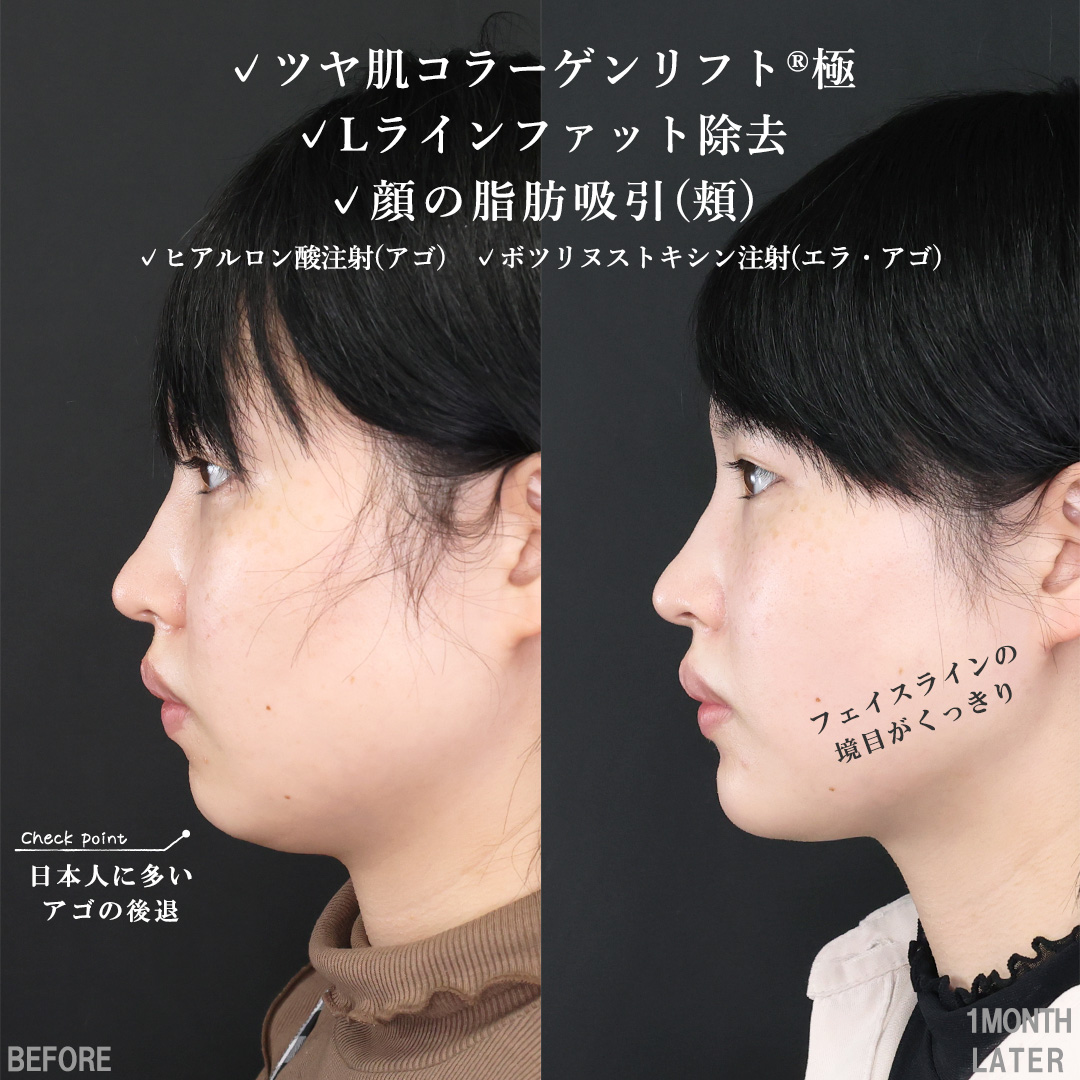 TAC式 ツヤ肌コラーゲンリフト®/Lラインファット除去(エラ下脂肪除去)/顔の脂肪吸引の症例写真 施術前後