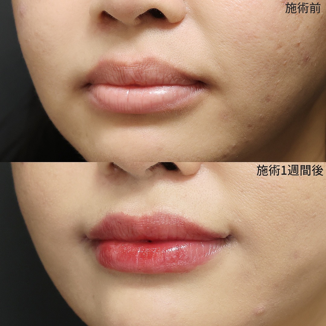 《口角リフト》で無意識でも口元美人へ
